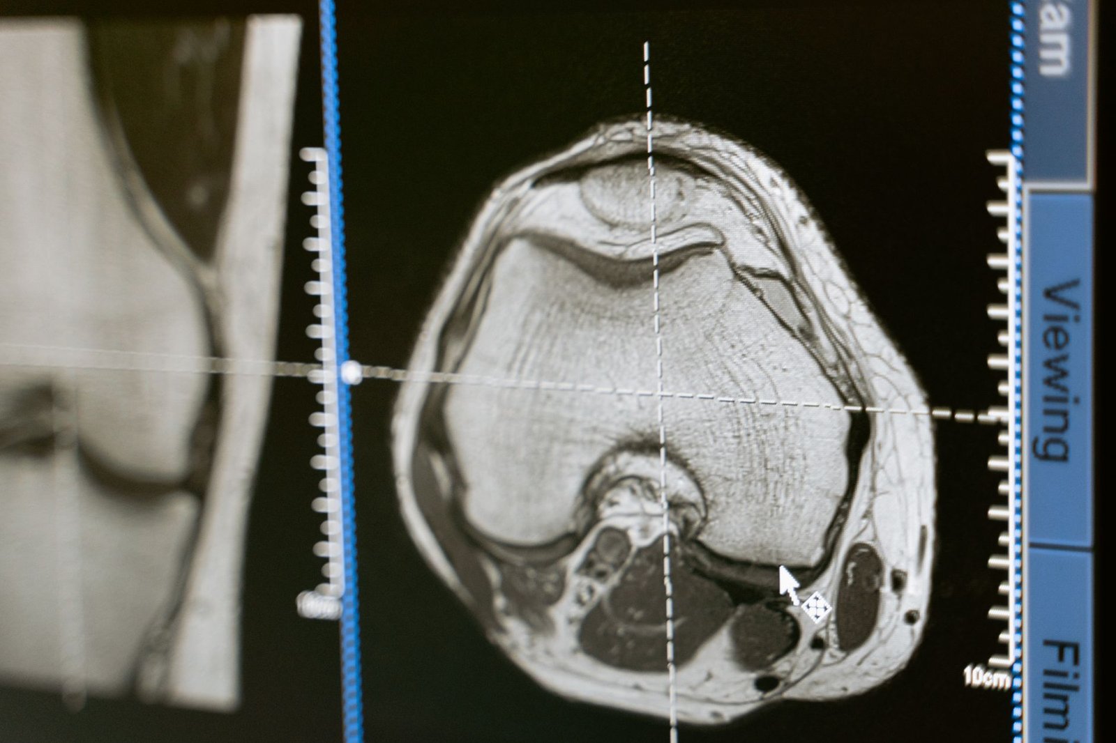 Sagittal and axial MRI slices of a knee displayed side by side on a radiology viewing workstation