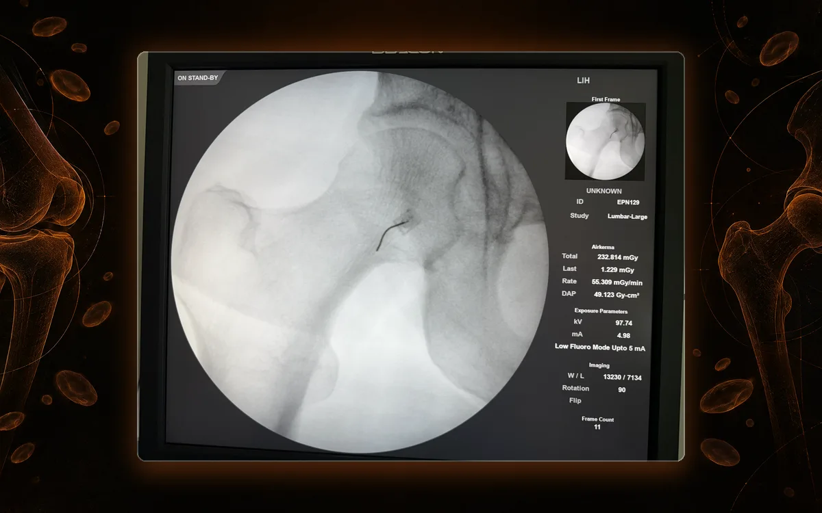 Fluoroscopy of the hip joint with the needle in position for an intra-articular hip injection at our St. Louis clinic.