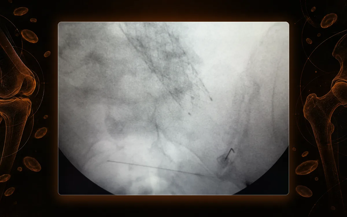 Fluoroscopy of the pelvis with the needle at the sacroiliac joint during a sacroiliac joint injection.