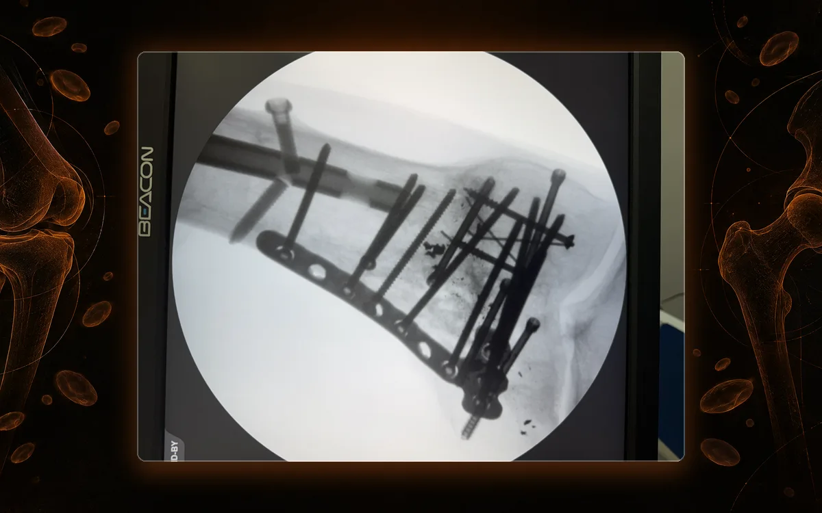 Fluoroscopy of a knee reconstructed with a plate and screws after trauma.