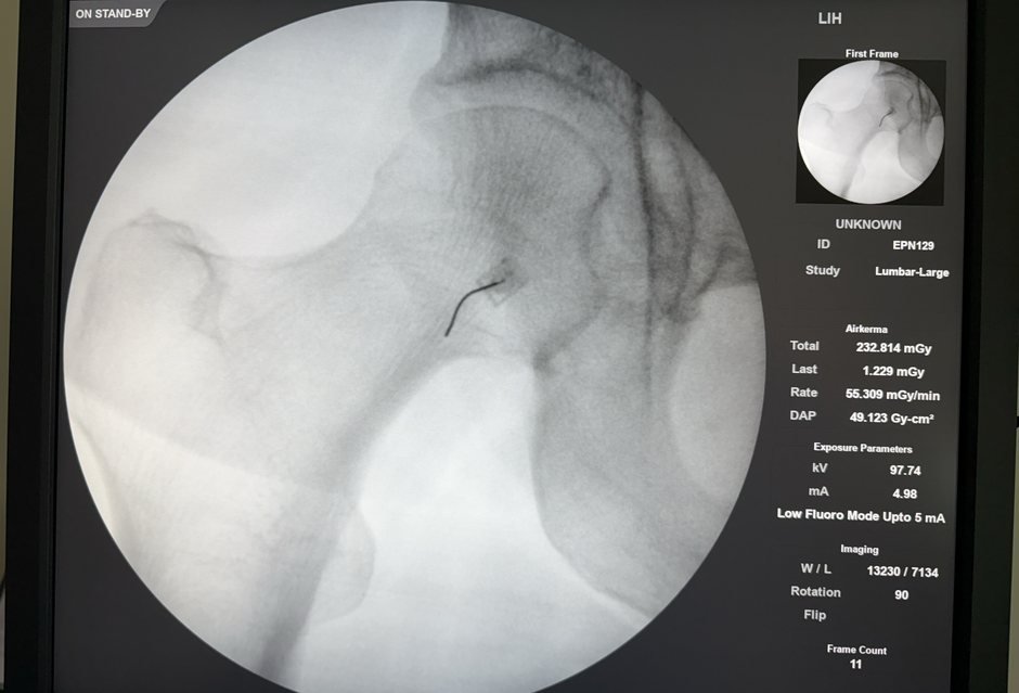 Fluoroscopic image of the hip joint with the needle in position for an intra-articular hip injection.