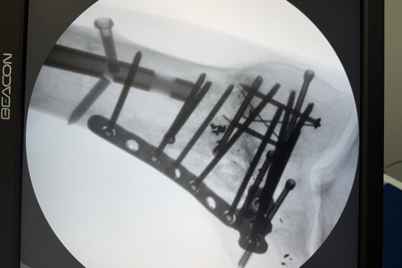 Fluoroscopic image of a knee reconstructed with a plate and screws after trauma.